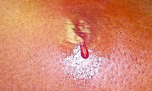 Pus Draining from Ruputured Abscess